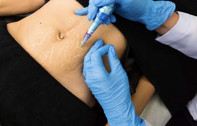 Scar Stretch Mark Camouflage