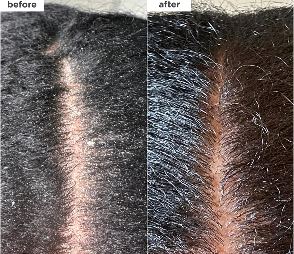 Nioxin Treatment