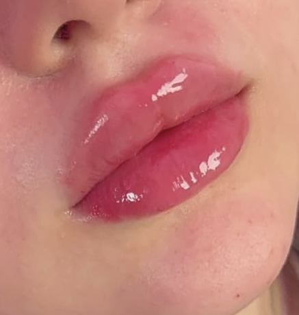 1.5 ML