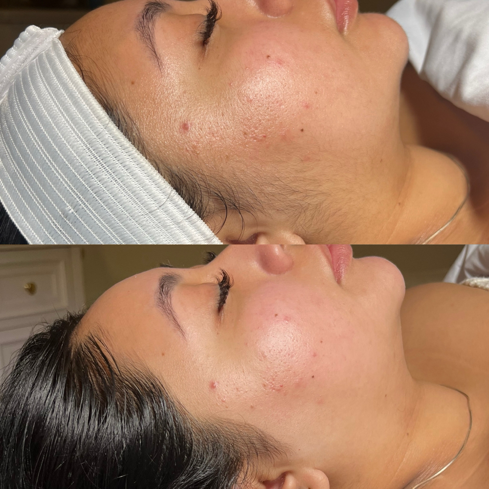 Express Dermaplane at CS Skin Studio in Chula Vista, CA