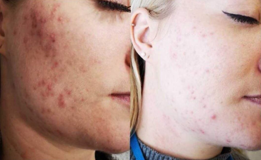 Acne Facial