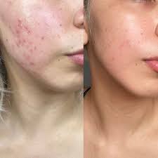 Acne Extraction Facial
