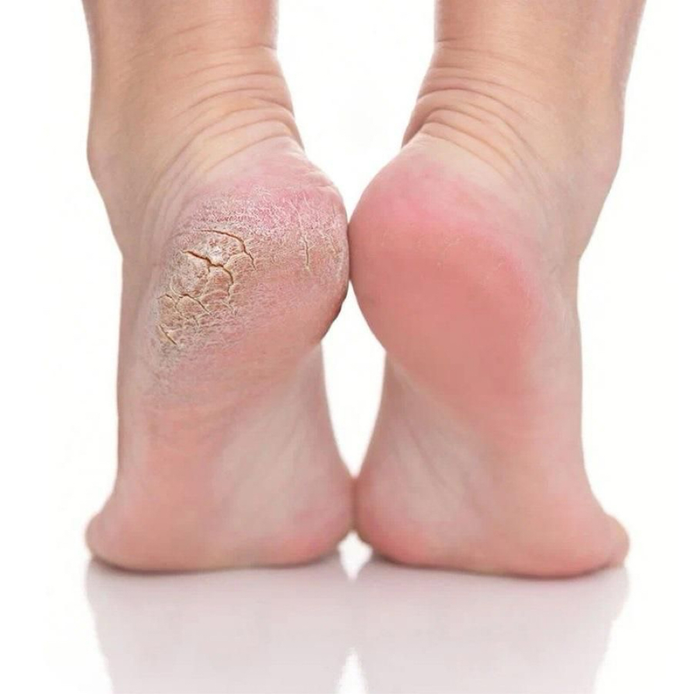 Callus Erase Pedi at DoneBycami Nail Studio in Royal Palm Beach, FL