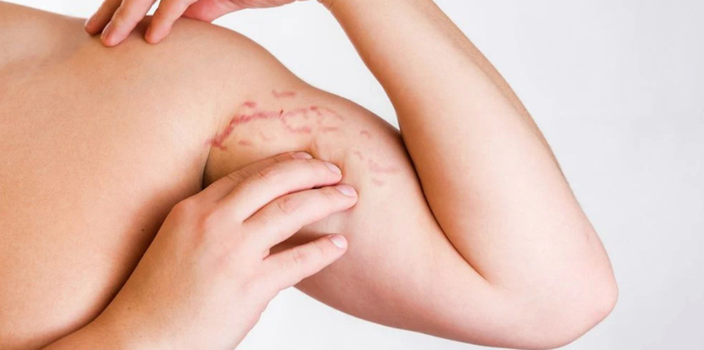 Bicep Stretchmark Camouflage