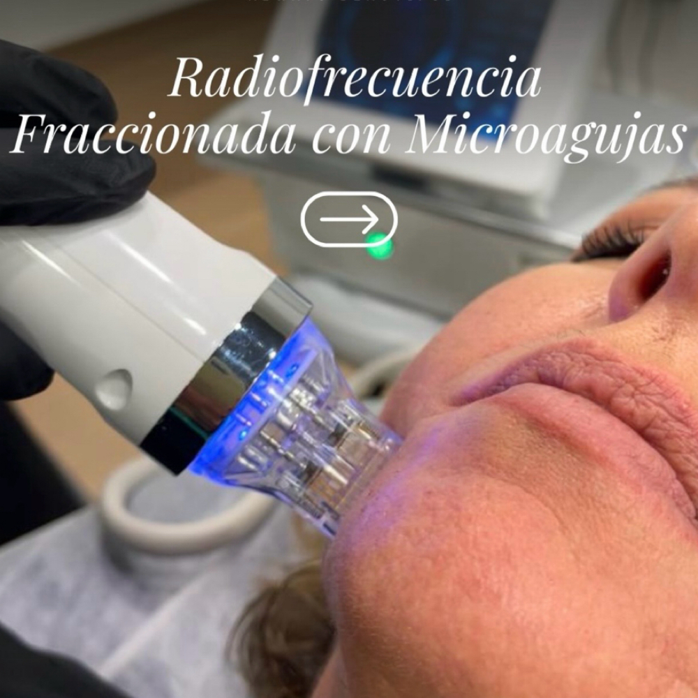 RF Fraccionada Con Microagujas at Korabela in Miami, FL