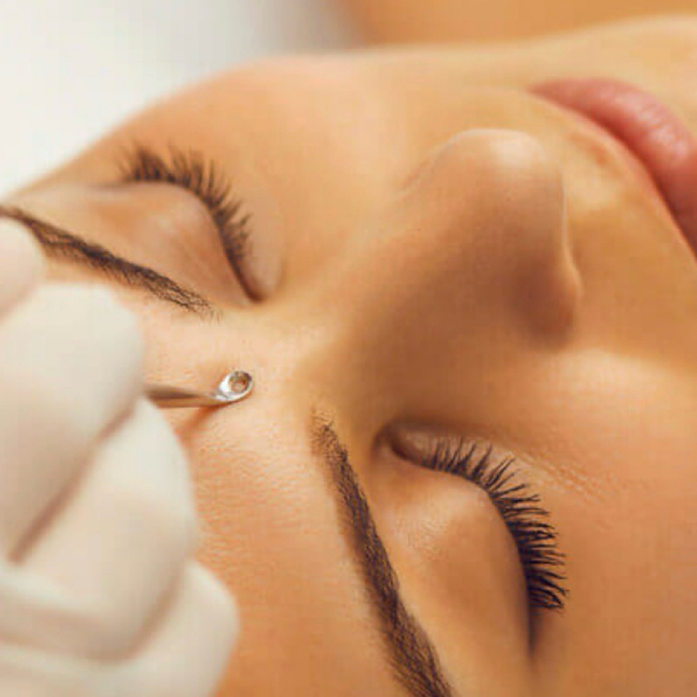 Peace Out Breakouts - Acne Facial at The Bubble Aesthetics and Spa in Soddy Daisy, TN