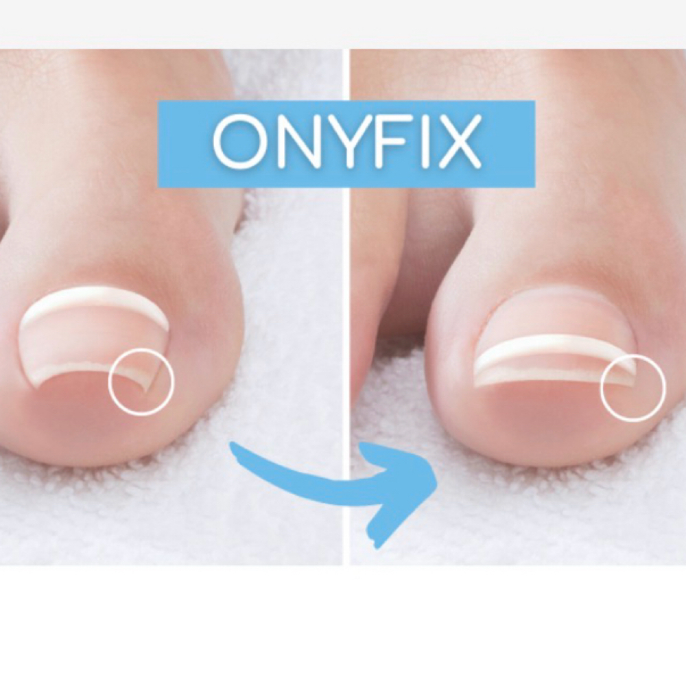 ONYFIX Ingrown Treatment at Lorna Rae Skincare in Pilot Point, TX