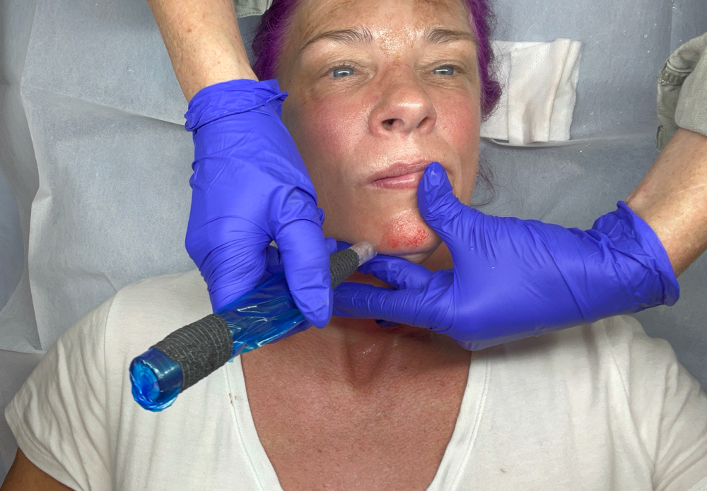 Procell Microneedling