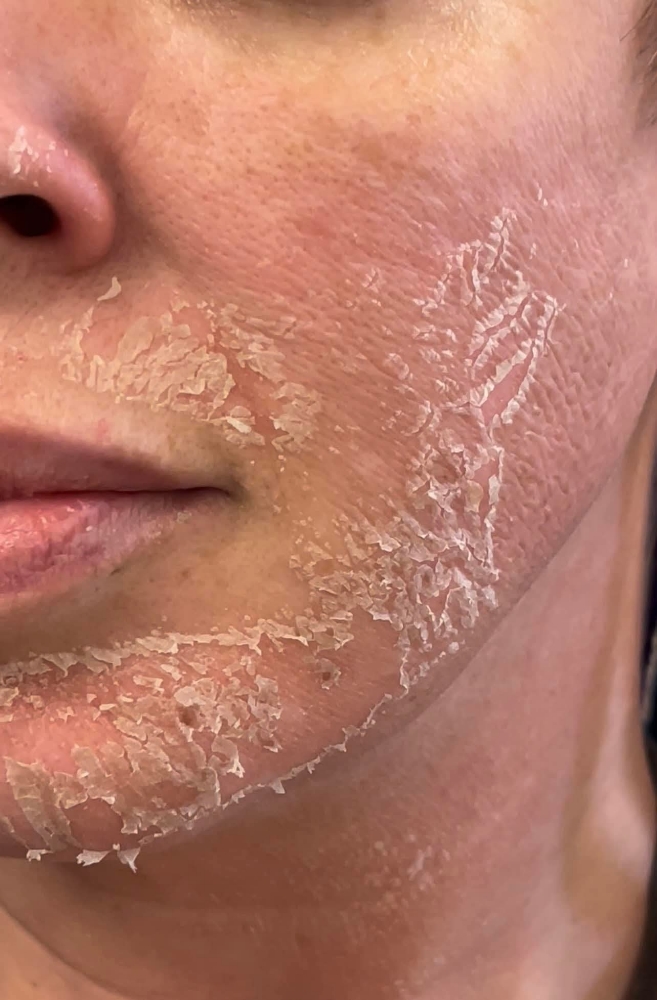 Chemical Peel Season