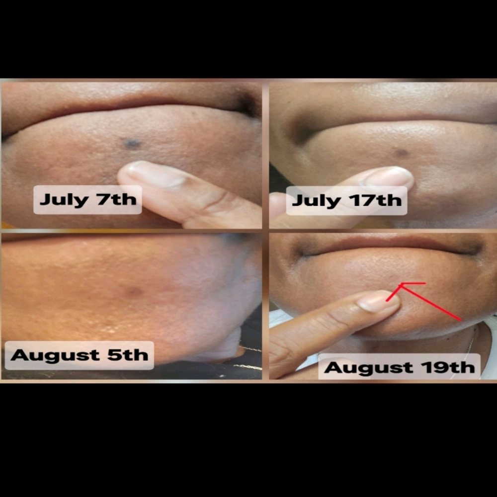 Virtual Hyperpigmentation Consult at Skin Romance Spa And Beauty Lounge in Clifton Heights, PA