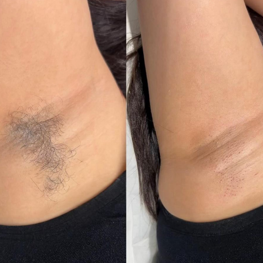 Underarm Wax at Ashlyn Rogers Esthetics in Paducah, KY
