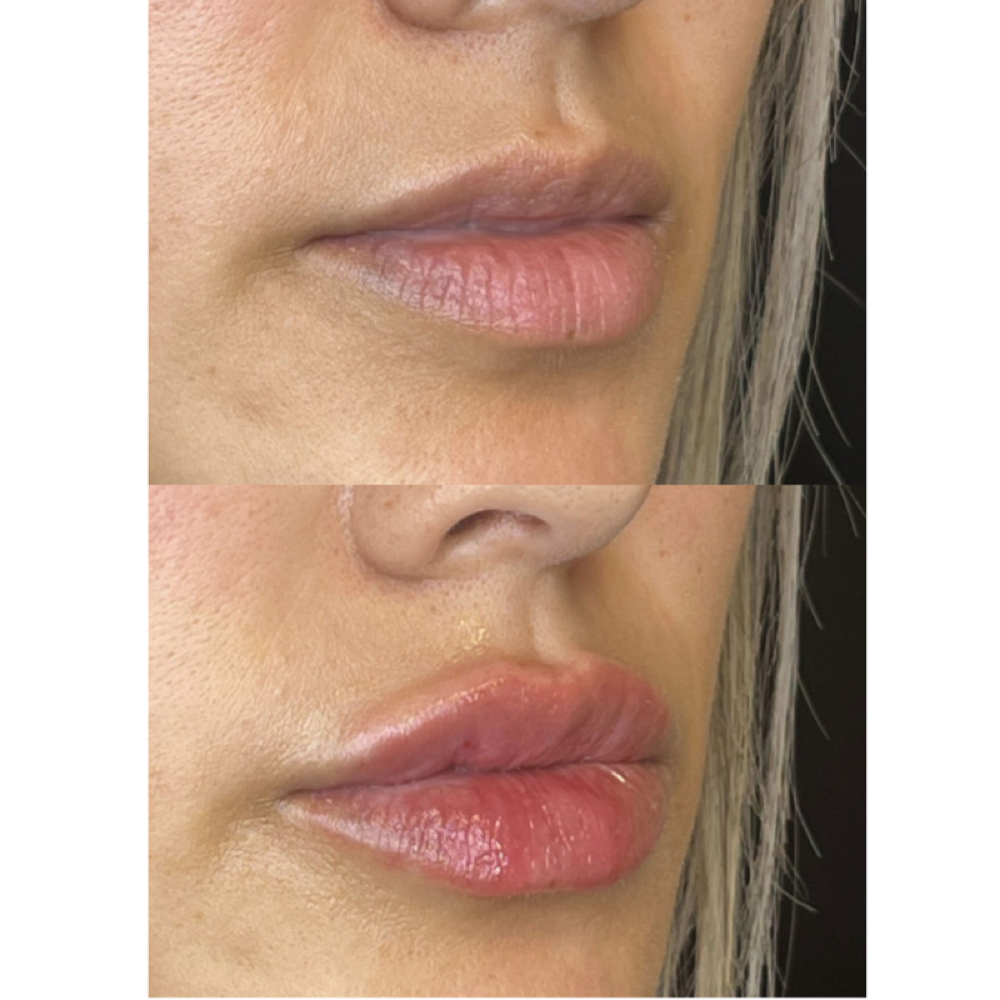 Juvederm Ultra XC Half Syringe at Hypnotic Aesthetic in Lavon, TX