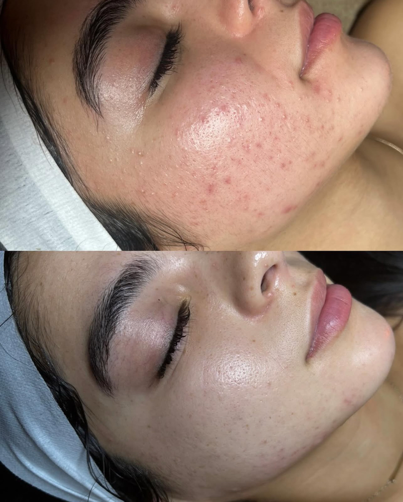 ACNE FACIAL