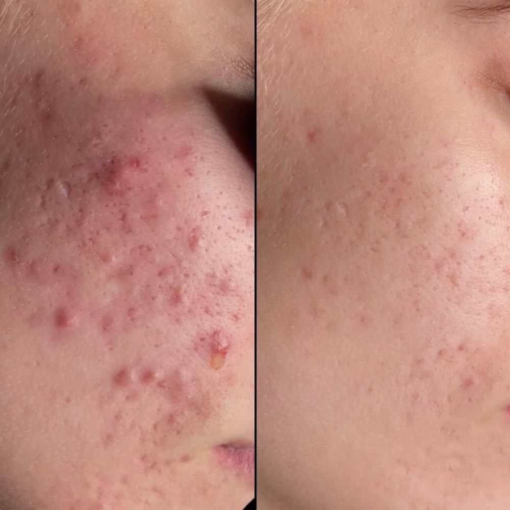 ACNE FACIAL at Bella Lash & Beauty in Cedar Grove, NJ