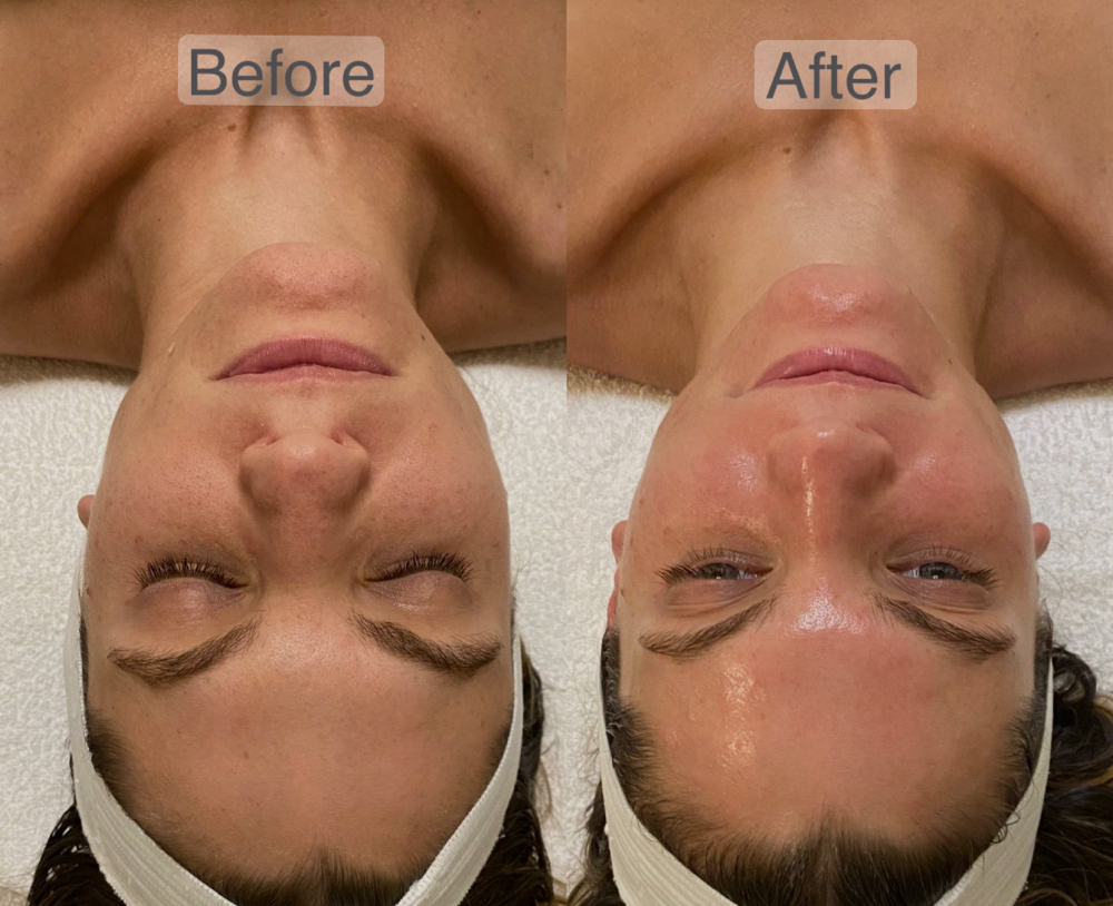 Microdermabrasion