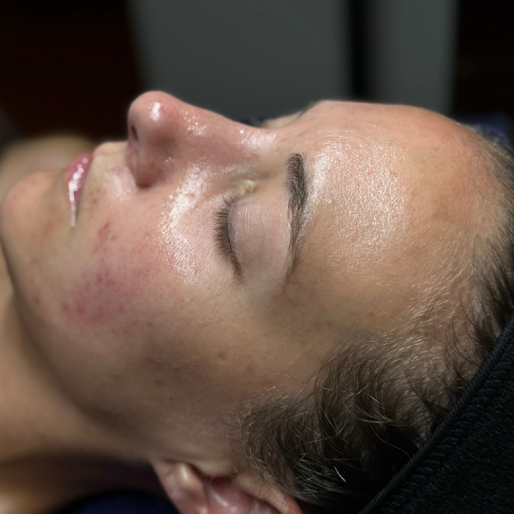 Acne Bootcamp Onboarding at Satin Skin Esthetics LLC in Glens Falls, NY