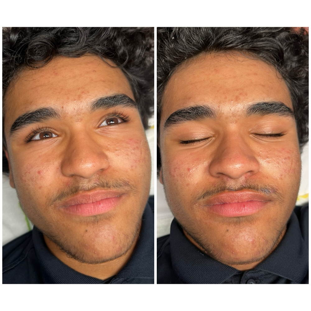 Teen Facial