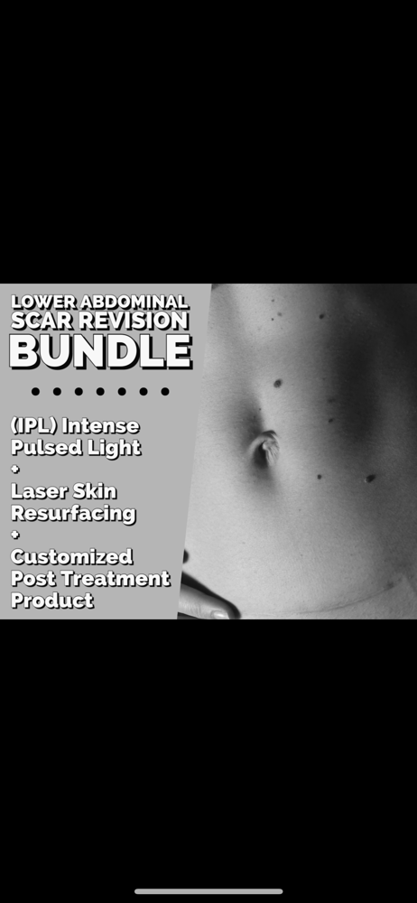 Lower Abs Scar Revision Bundle
