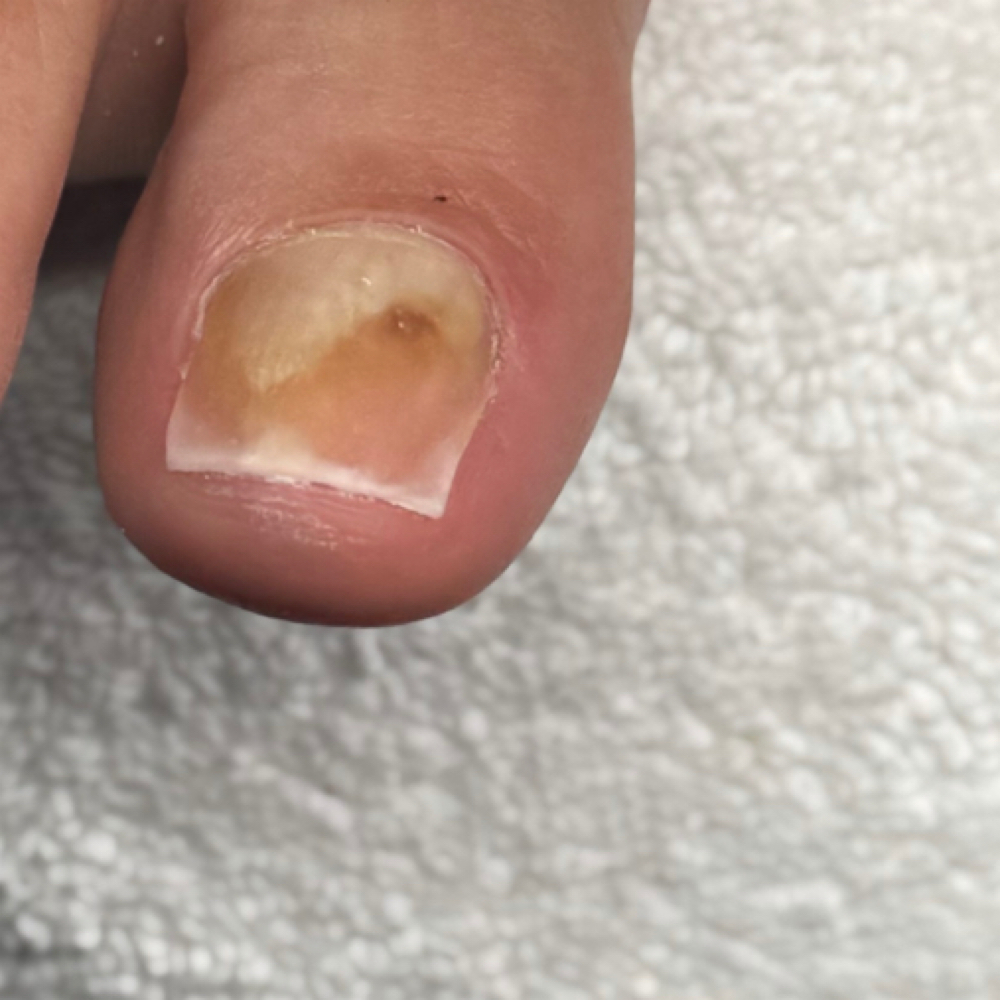 Nanoflex Toe Reconstruction at Dessys Nail Cave in Houston, TX