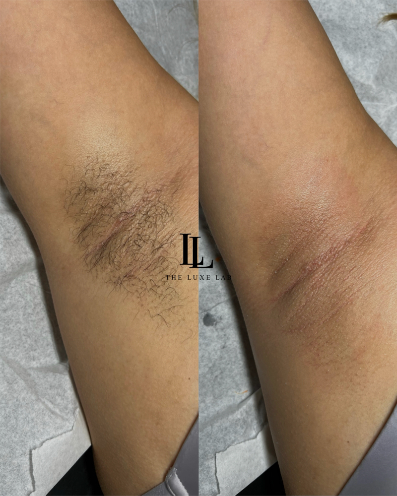 Underarms at The Luxe Lab in New Brunswick, NJ
