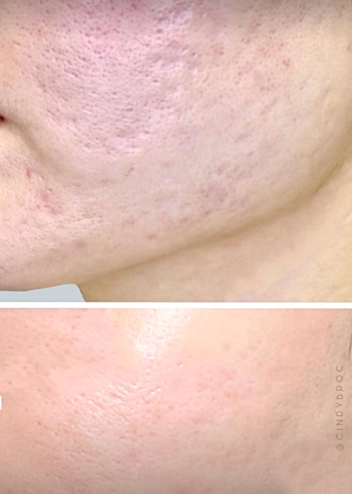 Acne scar Minimalization