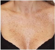 Chest Chemical Peel