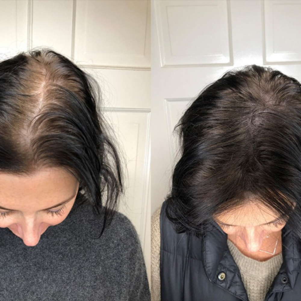 Scalp Micropigmentation at Perma Glow Shanna in Elmhurst, NY