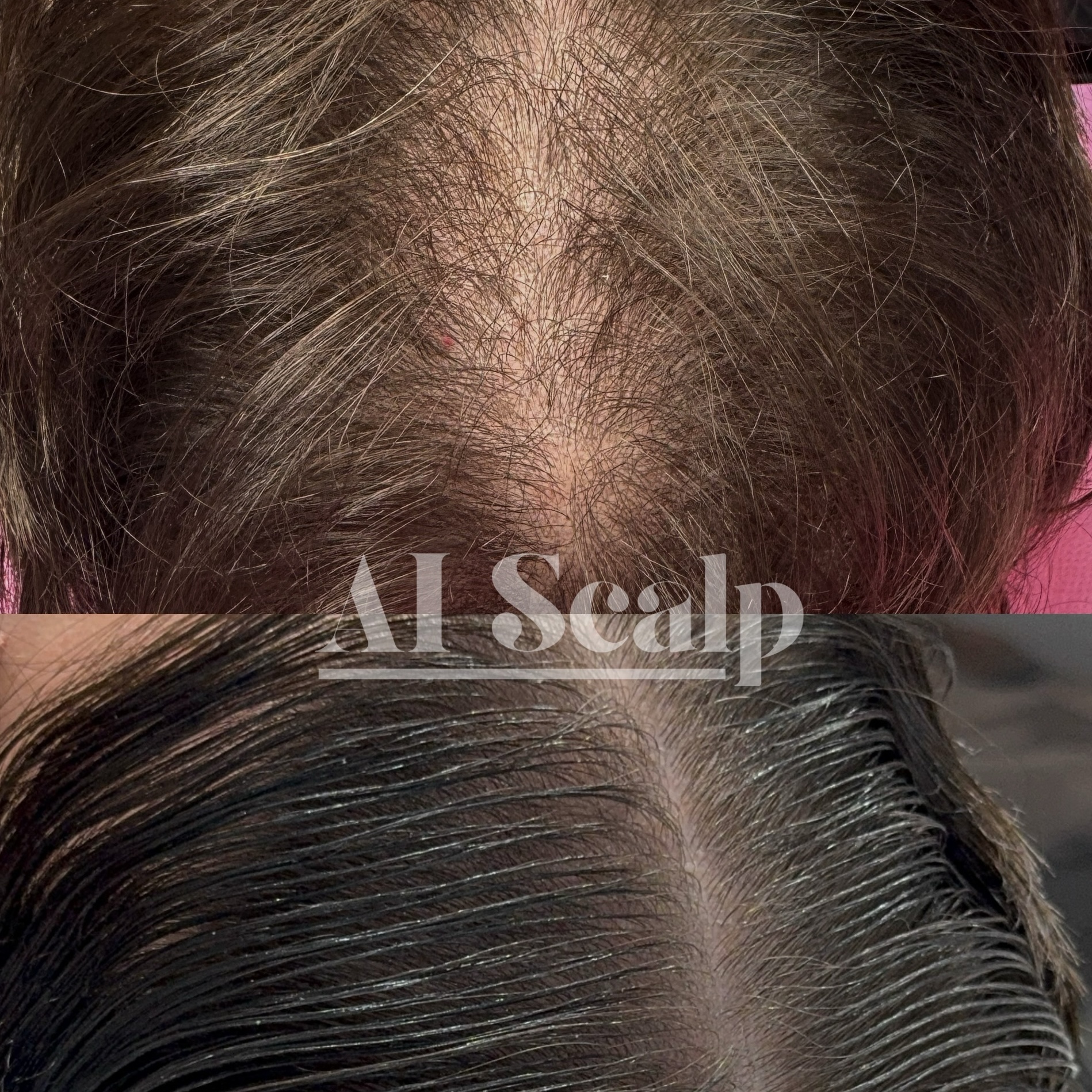 Ai Scalp - 3pk/2-3 zones at Alchemy Haus by Devyn | Color. Extensions. Scalp Density. in Atlanta, GA
