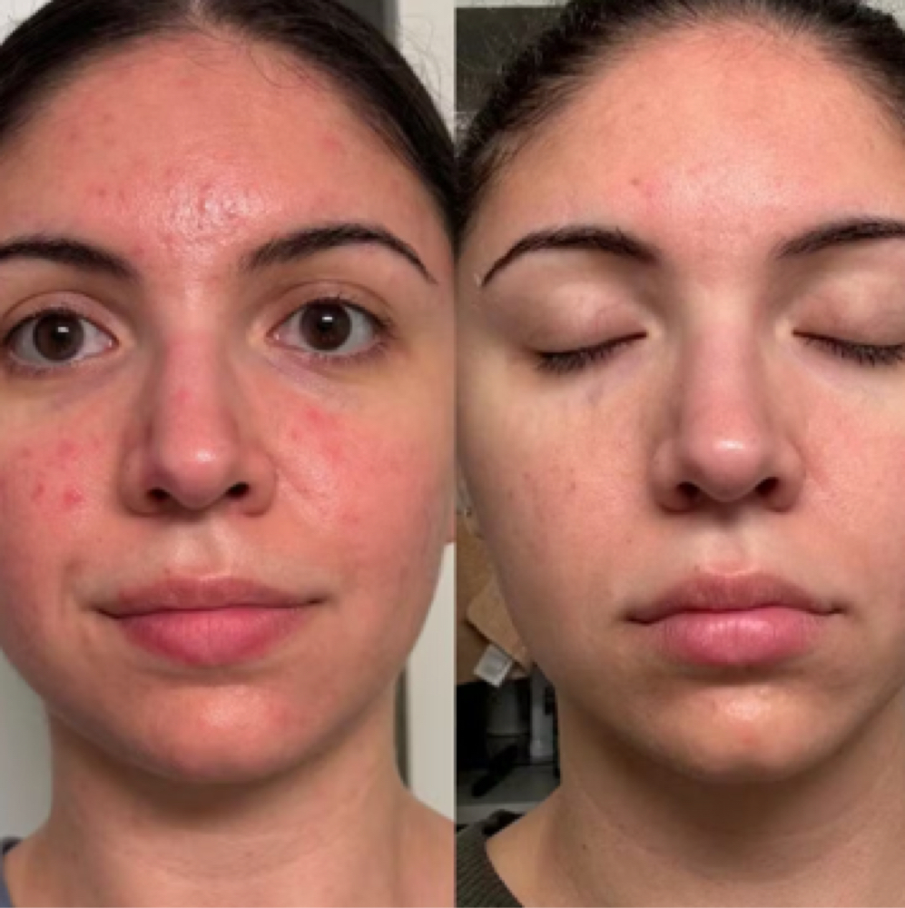 Chemical Peel Package (3) at The Full Edit Aesthetic Studio in Florence, AL