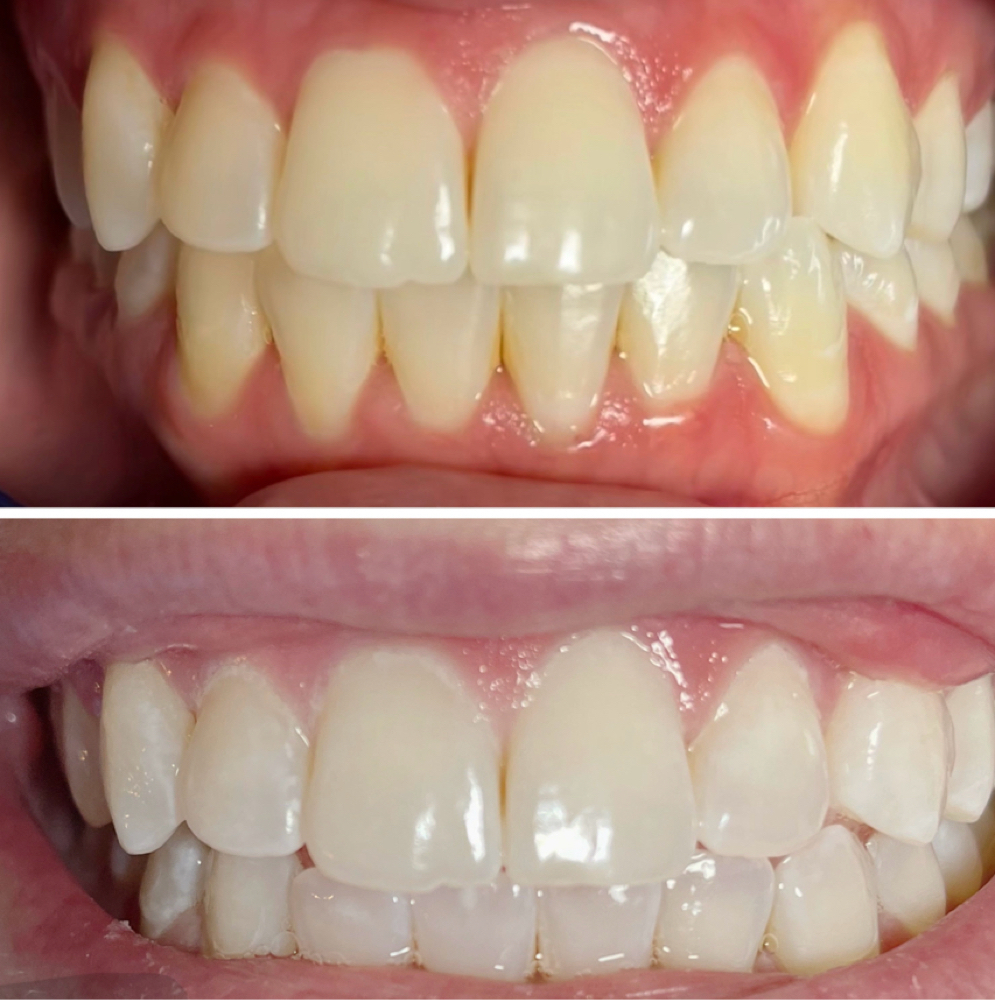 Sensitive Teeth Whitening at TANW/KII in Waterville, ME