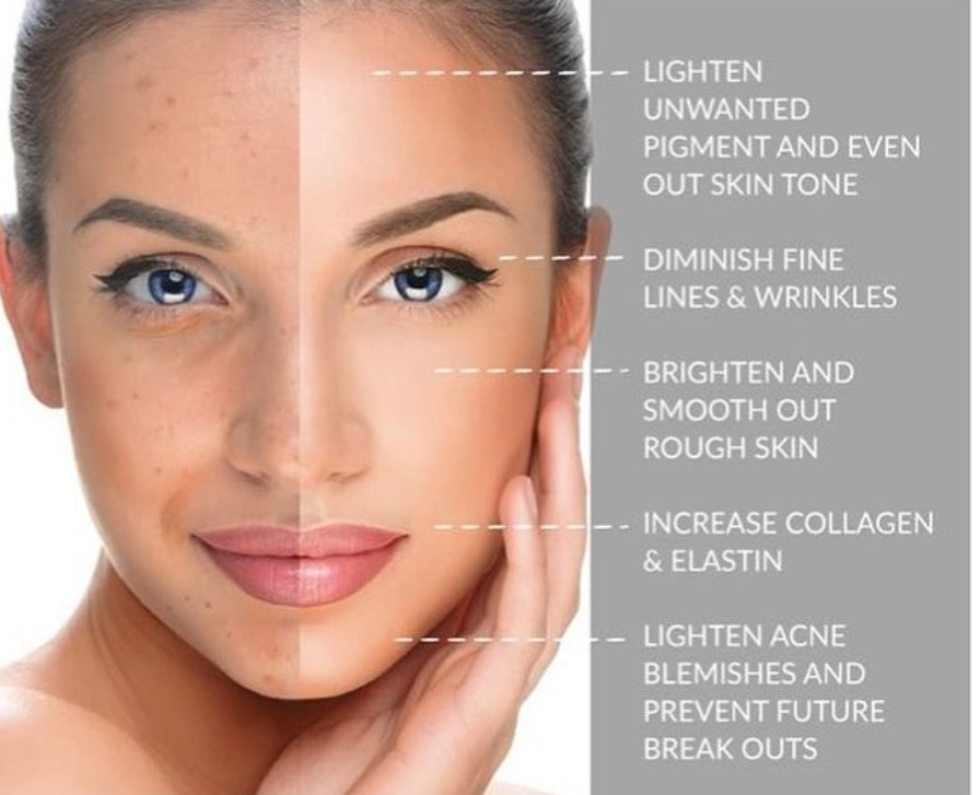 Chemical peel at Skin & Toxx in Houston, TX