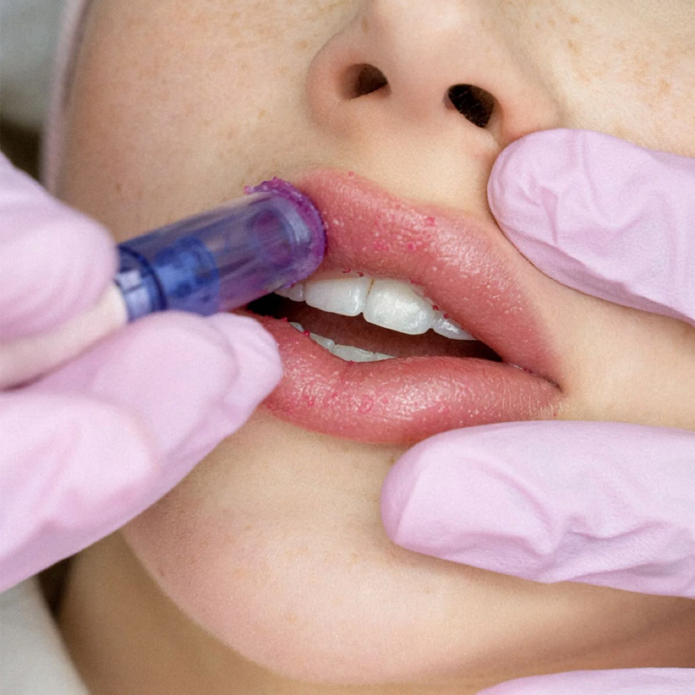 Luxe Lip Exfoliation at Vanessa Yarce in Miami, FL