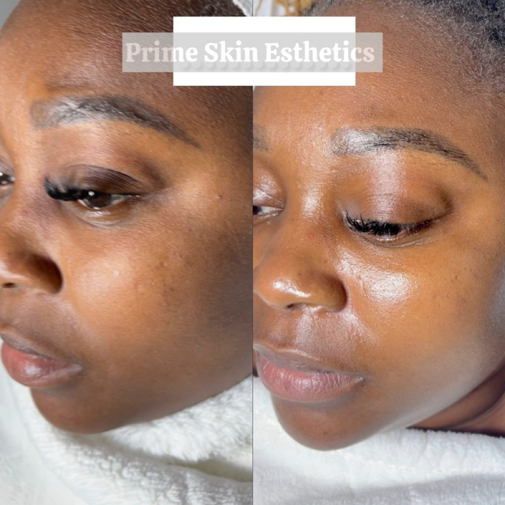 PROCELL Anti-aging & Scaring Facial at Prime Skin  Esthetics in Belleville, NJ