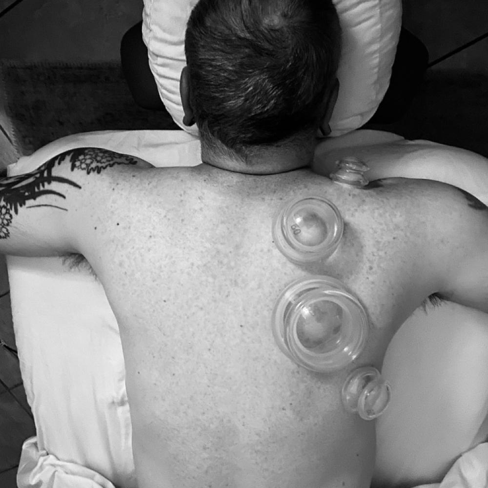 Cupping Therapy
