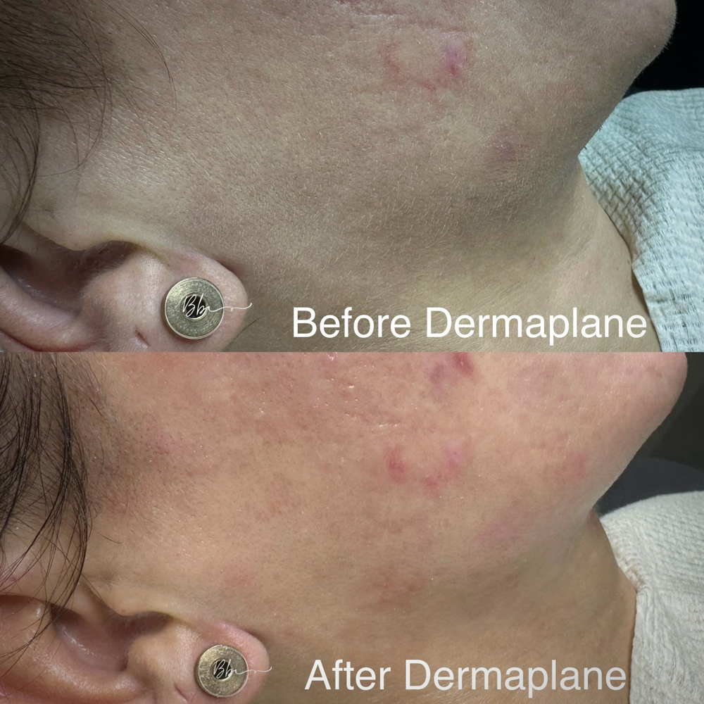 Dermaplane + Rapid Hydration Facial