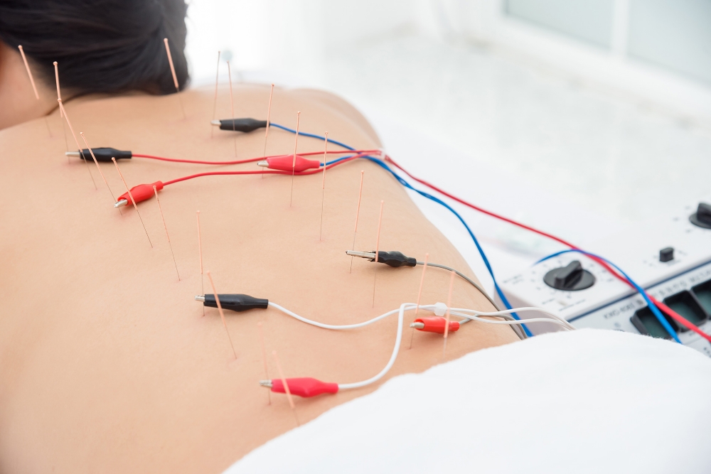 Dry Needling with Estim