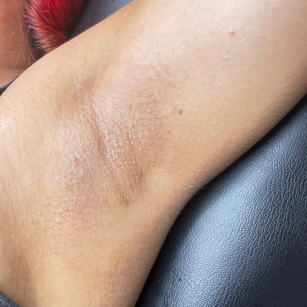 Underarms at CON AMOR ESTHETICS in Los Angeles, CA