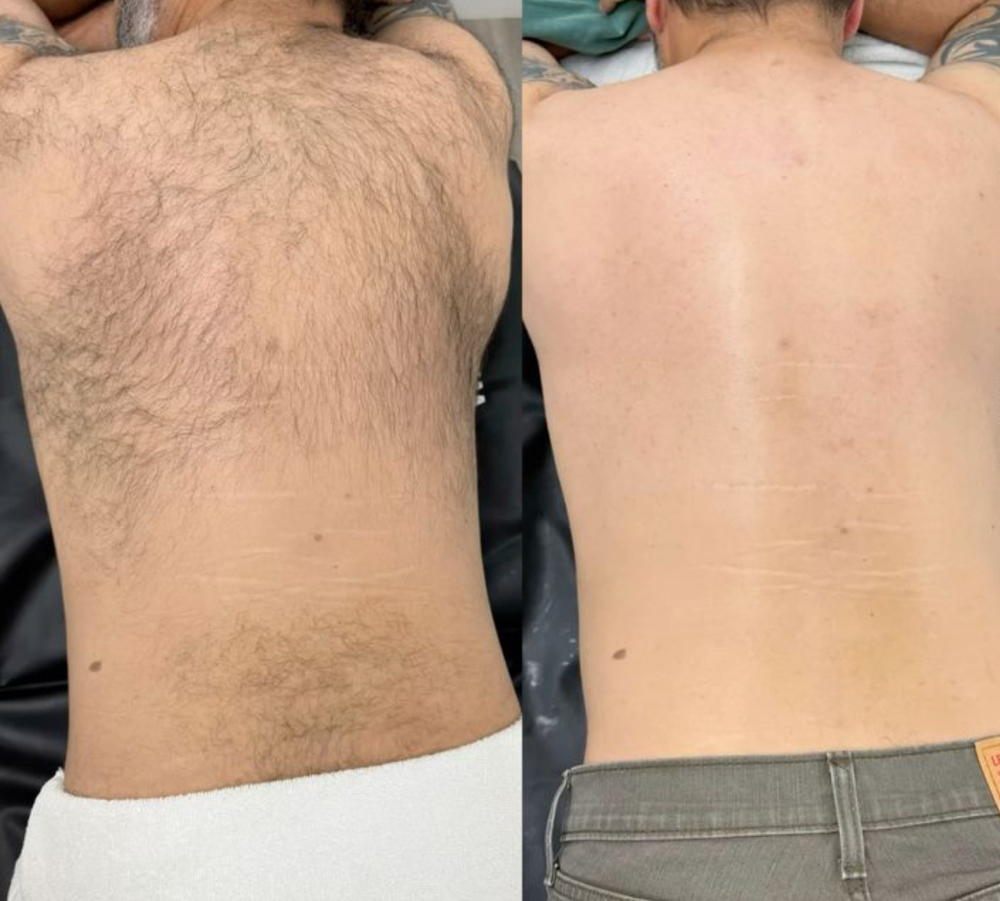 Back Waxing ( Depilacion - Espalda)