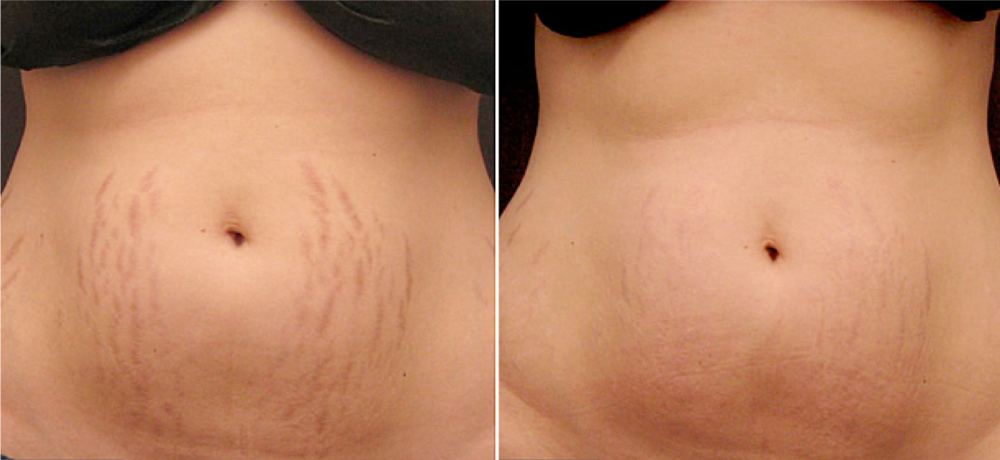 Stretch Mark Rejuvenation