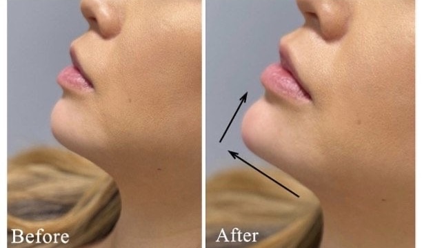 Chin Filler at Skin Savvy Aesthetics in Longview, TX