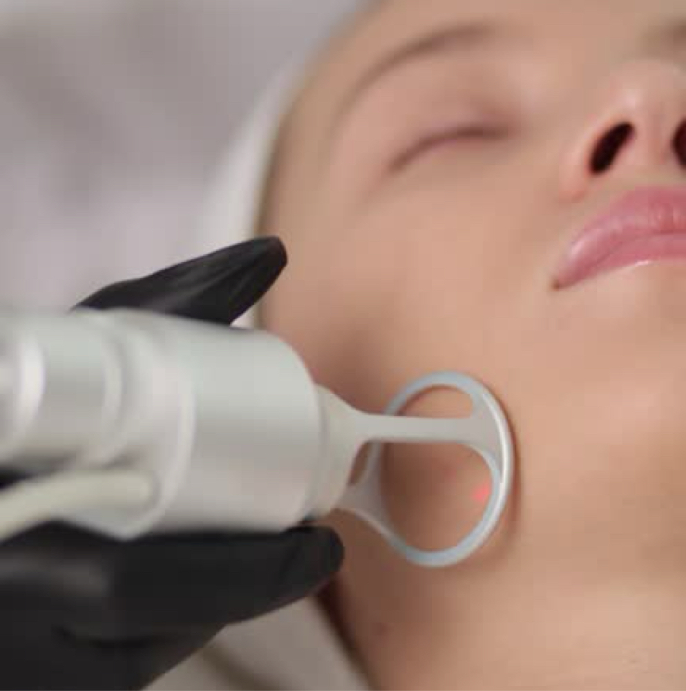 C02 Laser Resurfacing