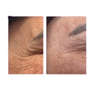 Plasma Lift