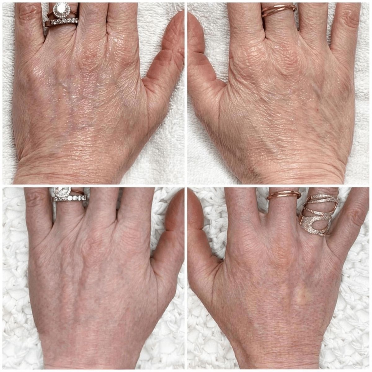 Subnovii Plasma Pen at CIAO AESTHETICS in Youngstown, OH