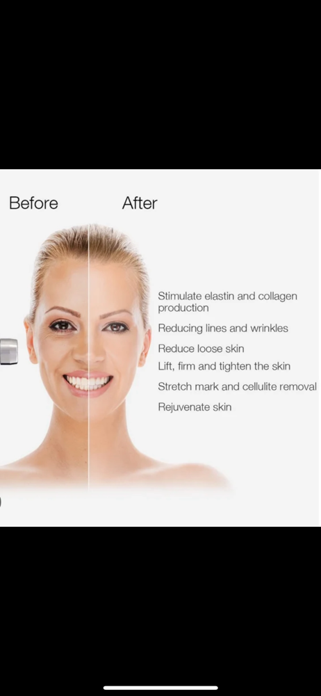 Enchantè RF Mini Face Tight