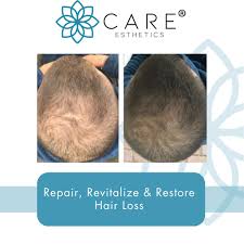 Hair Restoration PRF X 1