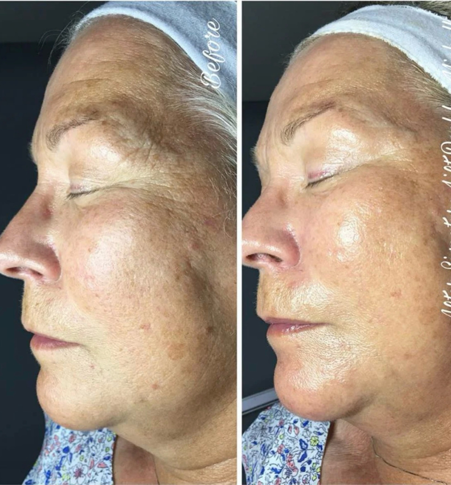 Signature facelift peel