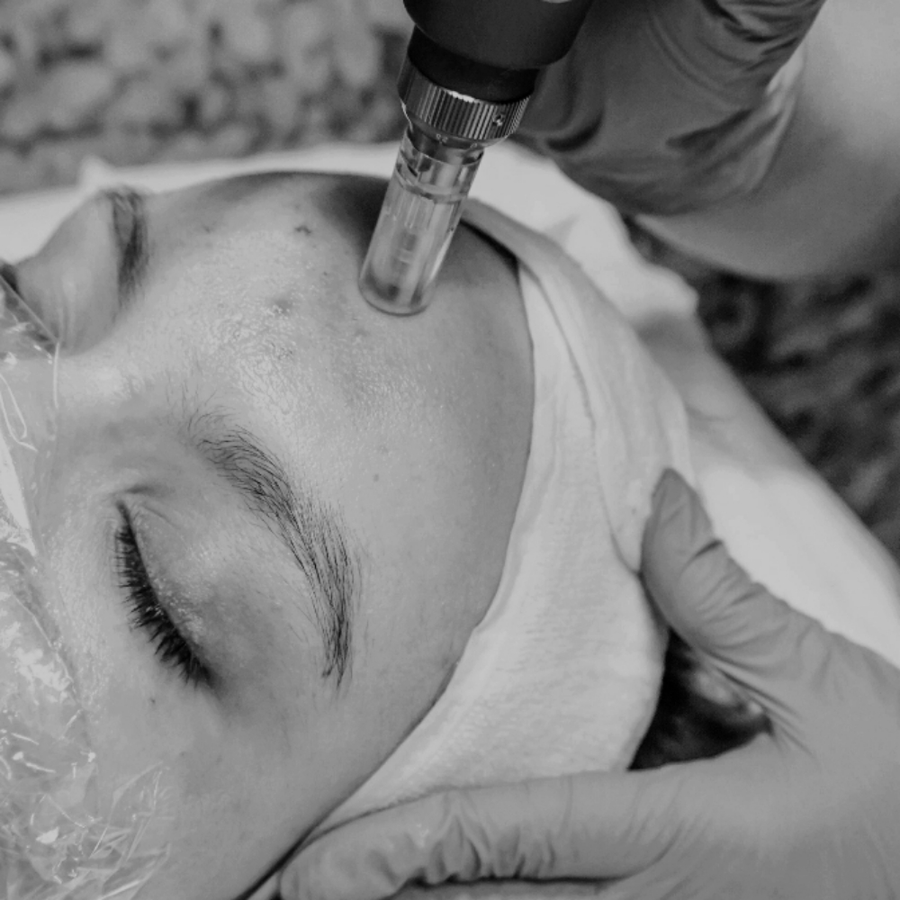 Microneedling Small Area at The Neon Door in Tucson, AZ