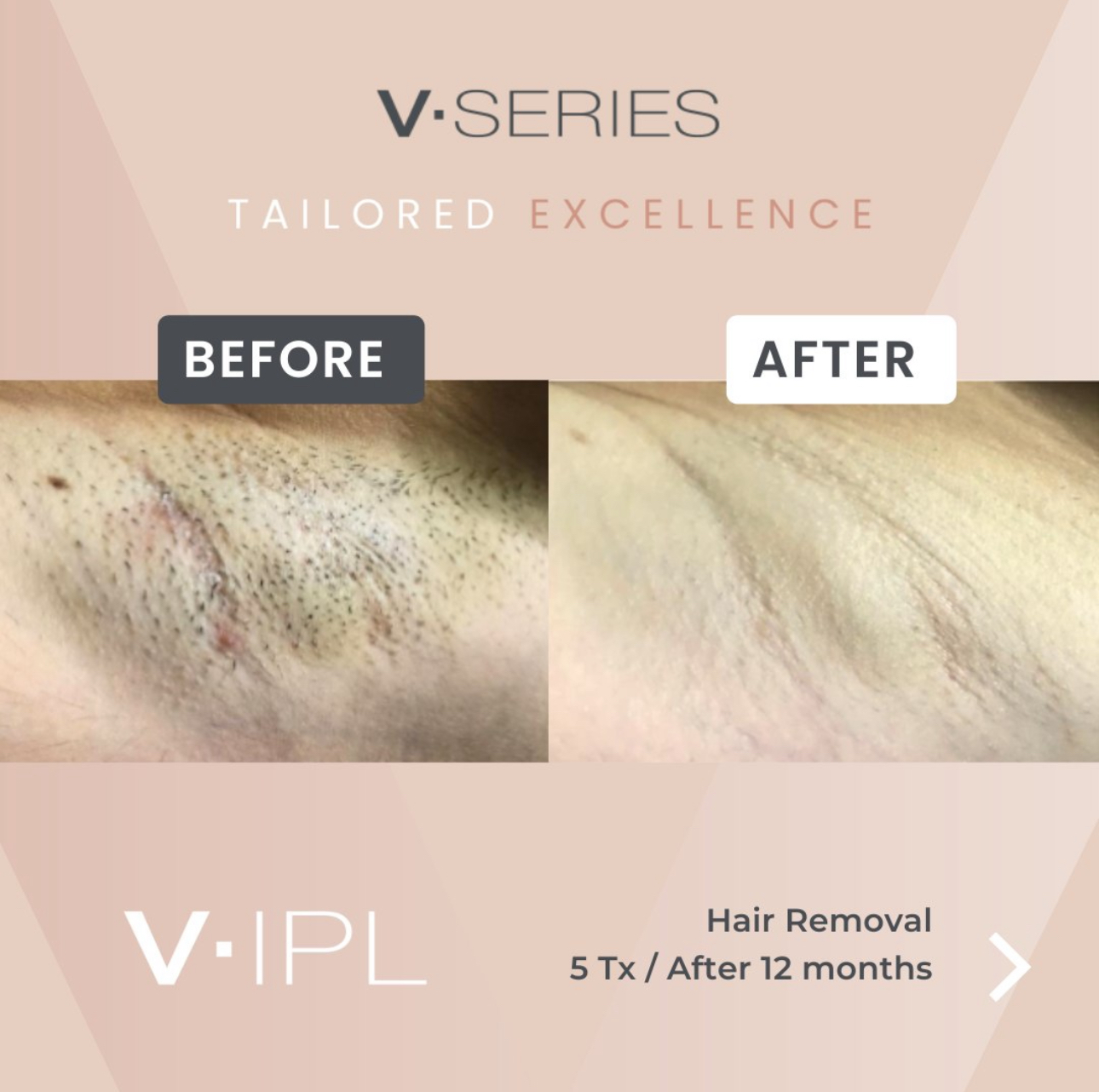 Laser Hair Removal Underarms at Magnifique Laser Spa in Rockville Centre, NY