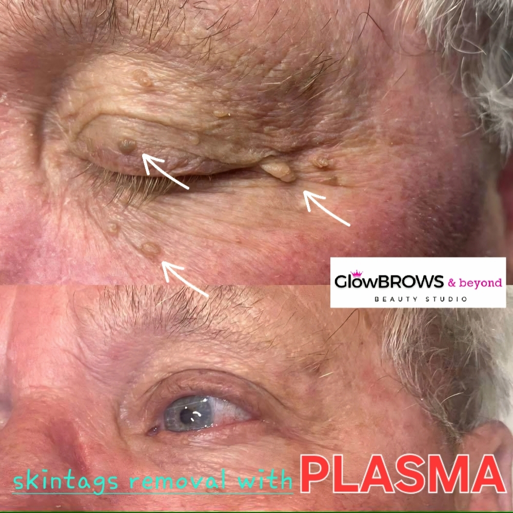 Skin Tag /Moles Removal at Glow Brows & Beyond in Hershey, PA
