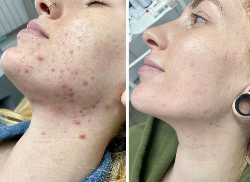 The acne & congestion clearing peel